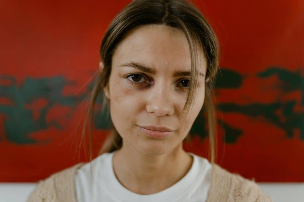 woman with a bruise on eye