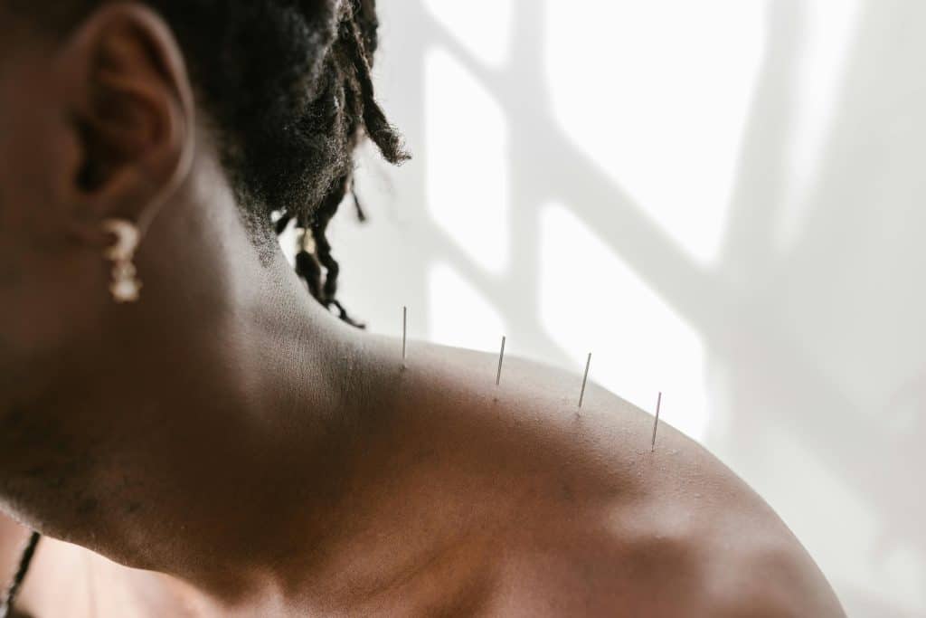 lady getting an acupuncture